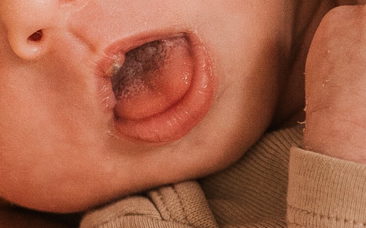 verkürztes Zungenband